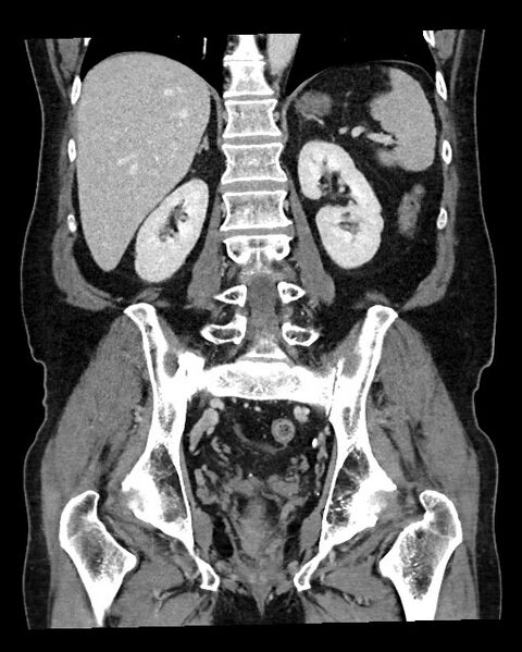 File:Acute appendicitis - large appendicoliths (Radiopaedia 61805-69820 Coronal C+ portal venous phase 90).jpg