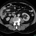 Acute appendicitis arising from a malrotated cecum (Radiopaedia 19970-19997 Axial C+ portal venous phase 17).jpg