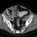 Acute appendicitis arising from a malrotated cecum (Radiopaedia 19970-19997 Axial C+ portal venous phase 39).jpg