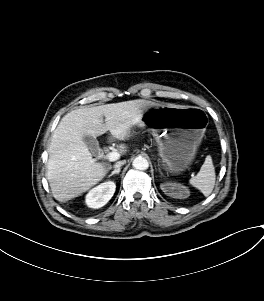 Acute arterial mesenteric ischemia (Radiopaedia 78238-90828 Axial C+ portal venous phase 36).jpg