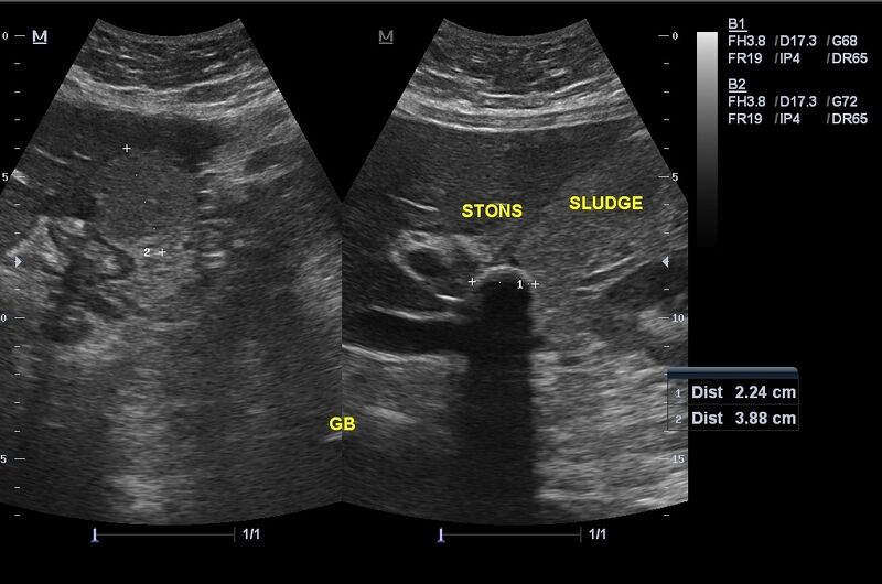 File:Acute calculous cholecystitis (Radiopaedia 16997-16703 Left image transverse and the right is longitudinal 1).jpg