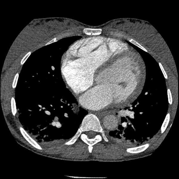 File:Acute chest syndrome - sickle cell disease (Radiopaedia 42375-45499 Axial C+ CTPA 117).jpg