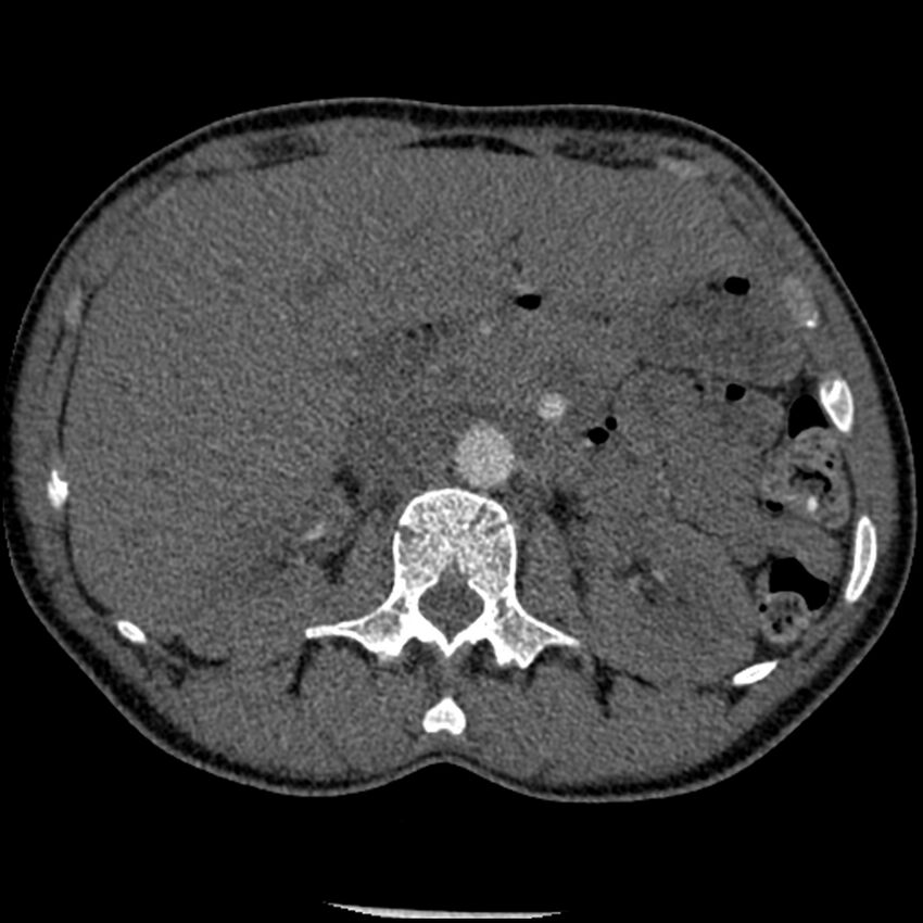Acute chest syndrome - sickle cell disease (Radiopaedia 42375-45499 Axial C+ CTPA 232).jpg