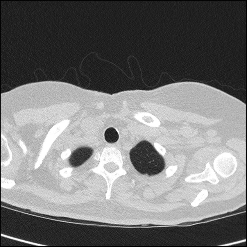 Acute interstitial pneumonitis (Radiopaedia 45404-49453 Axial lung window 7).jpg