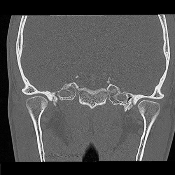 File:Acute otomastoiditis (Radiopaedia 28329-28575 Coronal bone window 16).jpg