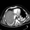 Acute pancreatic necrosis (Radiopaedia 13560-13486 Axial C+ portal venous phase 18).jpg