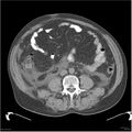 Acute pancreatitis (Radiopaedia 19135-19116 Axial non-contrast 34).jpg