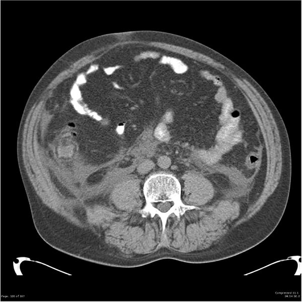 File:Acute pancreatitis (Radiopaedia 19135-19116 Axial non-contrast 34).jpg