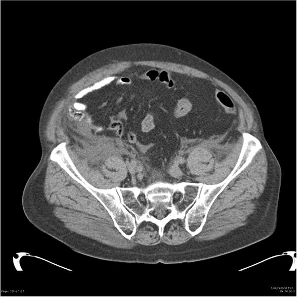 File:Acute pancreatitis (Radiopaedia 19135-19116 Axial non-contrast 47).jpg