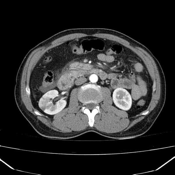 File:Acute pancreatitis (Radiopaedia 22572-22596 Axial C+ arterial phase 35).jpg