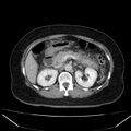 Acute pancreatitis - Balthazar C (Radiopaedia 26569-26714 Axial C+ portal venous phase 39).jpg