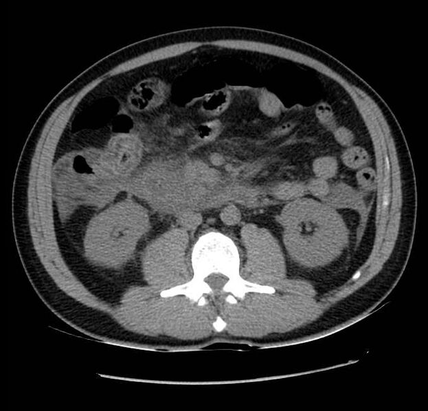 File:Acute pancreatitis - Balthazar E (Radiopaedia 23080-23110 Axial non-contrast 34).jpg
