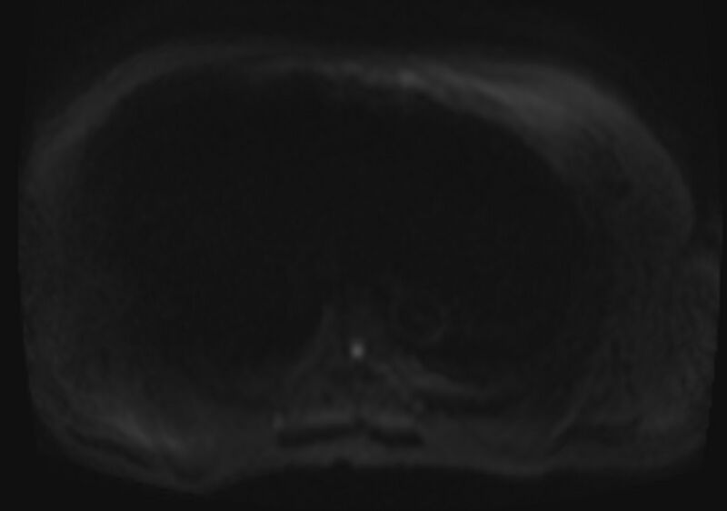 File:Acute portal vein thrombosis (Radiopaedia 73198-83925 Axial DWI 31).jpg
