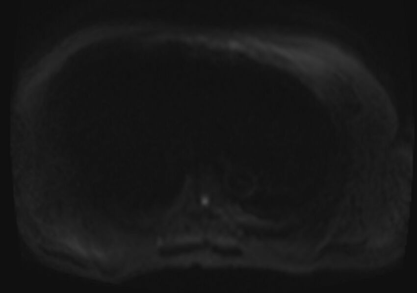 Acute portal vein thrombosis (Radiopaedia 73198-83925 Axial DWI 31).jpg