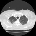 Acute pulmonary edema on CT (Radiopaedia 33582-34672 Axial lung window 7).jpg