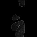 Acute pyelonephritis (Radiopaedia 25657-25837 Sagittal renal parenchymal phase 81).jpg