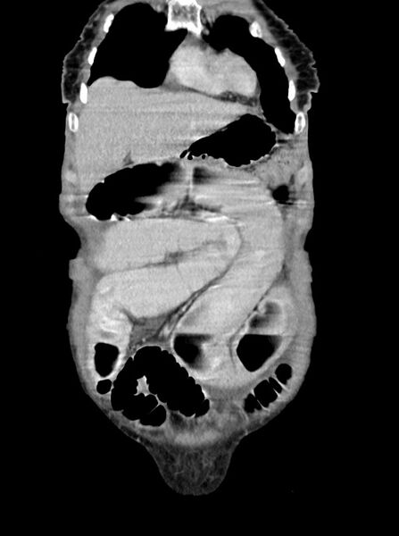 File:Acute small bowel (ileal) volvulus (Radiopaedia 71740-82139 Coronal C+ portal venous phase 22).jpg