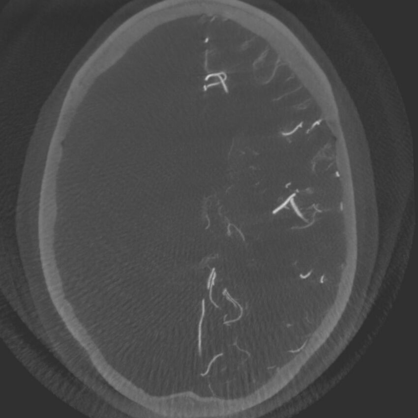 Acute subarachnoid hemorrhage and accessory anterior cerebral artery (Radiopaedia 69231-79010 C 43).jpg