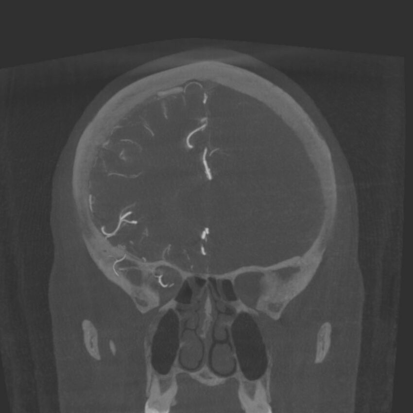 Acute subarachnoid hemorrhage and accessory anterior cerebral artery (Radiopaedia 69231-79010 Coronal arterial - MIP 31).jpg