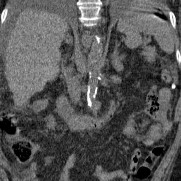 File:Acute tubular necrosis (Radiopaedia 28077-28334 C 2).jpg