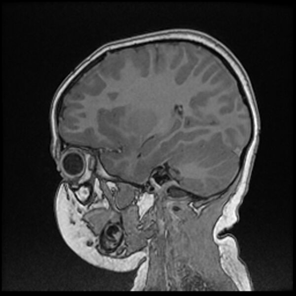 File:Adamantinomatous craniopharyngioma (Radiopaedia 77407-89529 Sagittal T1 C+ 92).jpg