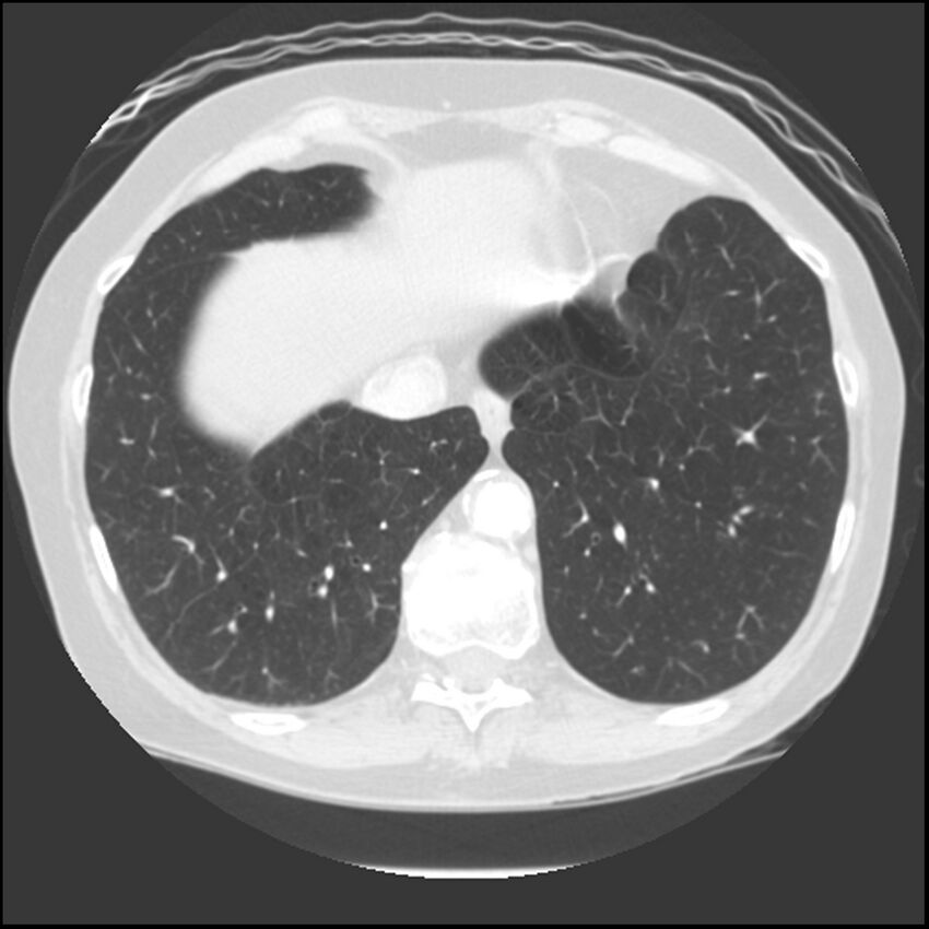 Adenocarcinoma of the lung (Radiopaedia 41015-43755 Axial lung window 98).jpg