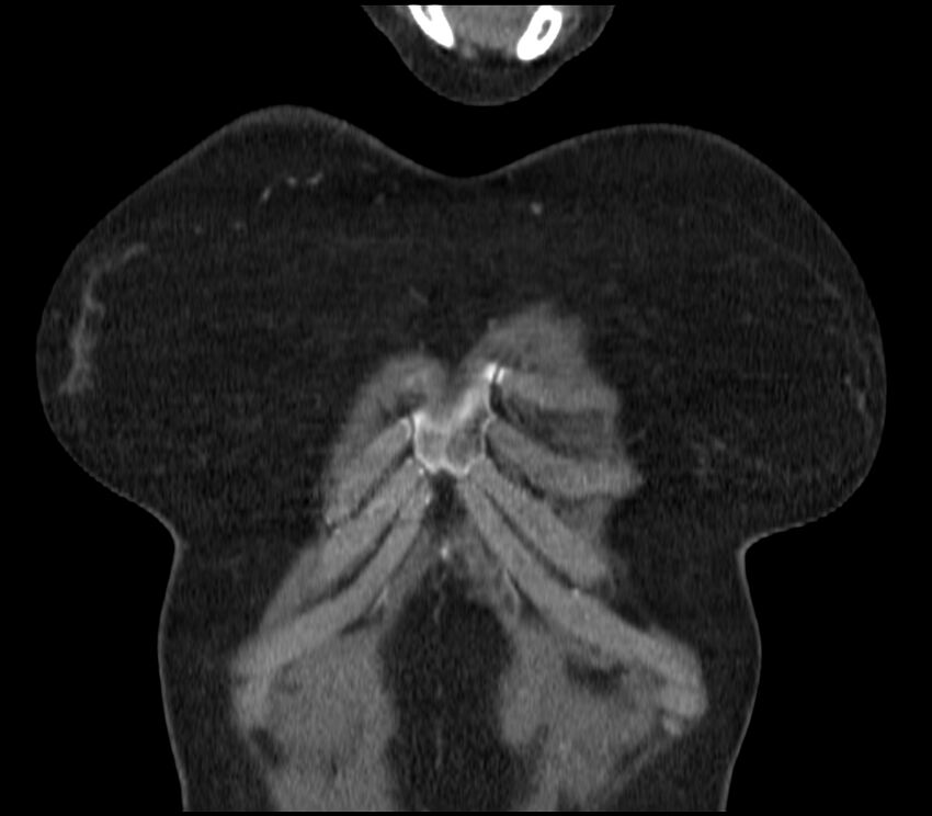 Adenocarcinoma of the lung (Radiopaedia 44205-47803 Coronal C+ portal venous phase 5).jpg