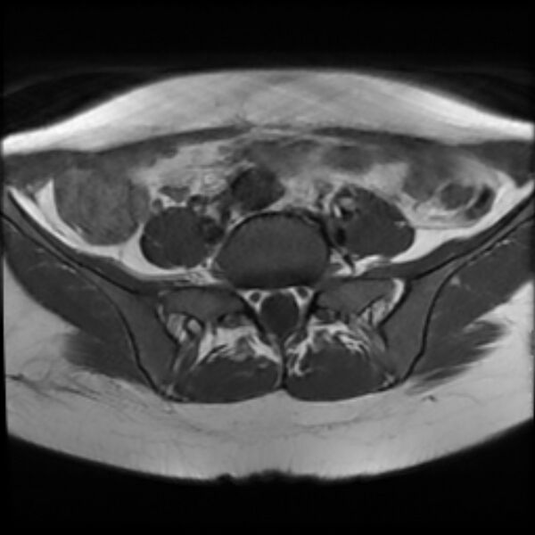File:Adenomyosis within a septate uterus (Radiopaedia 69963-79981 Axial T1 5).jpg
