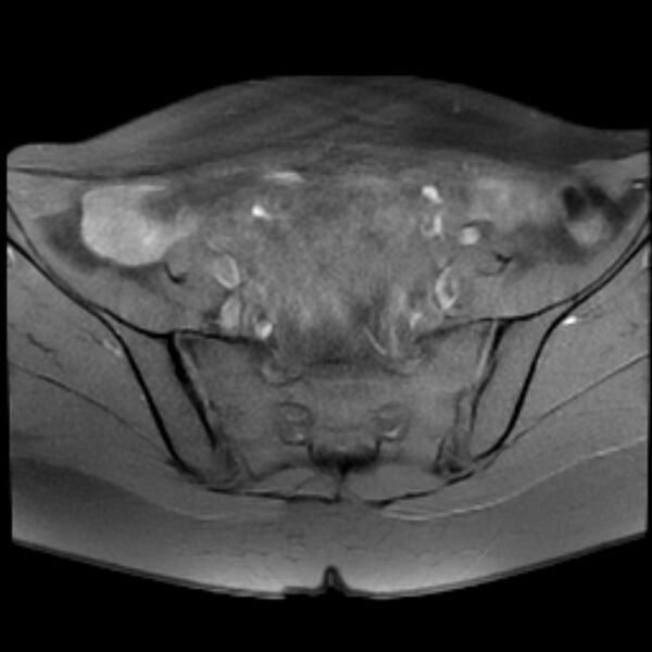 File:Adenomyosis within a septate uterus (Radiopaedia 69963-79981 Axial T1 fat sat 9).jpg