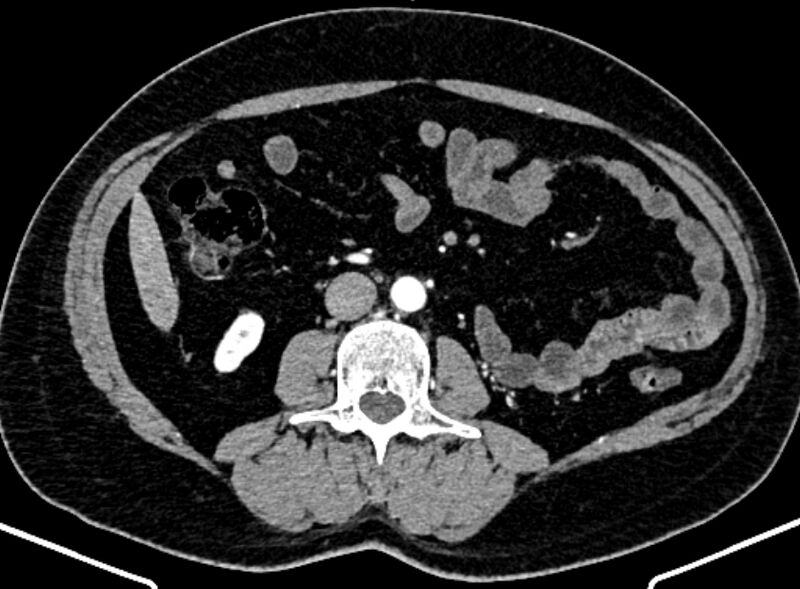 File:Adrenal metastases (Radiopaedia 73082-83791 Axial C+ arterial phase 99).jpg