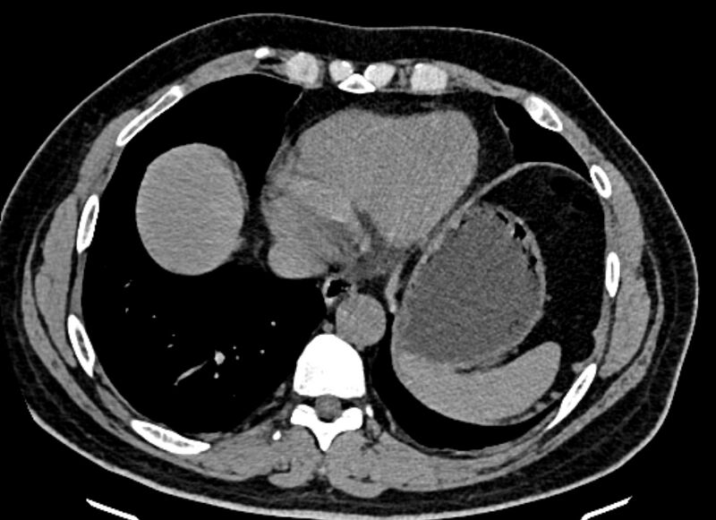 File:Adrenal metastases (Radiopaedia 73082-83791 Axial non-contrast 13).jpg