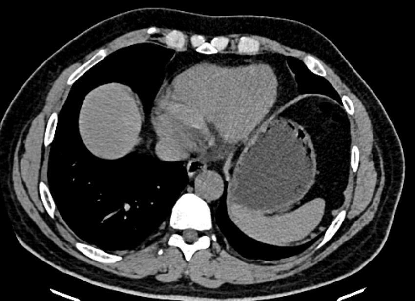 Adrenal metastases (Radiopaedia 73082-83791 Axial non-contrast 13).jpg