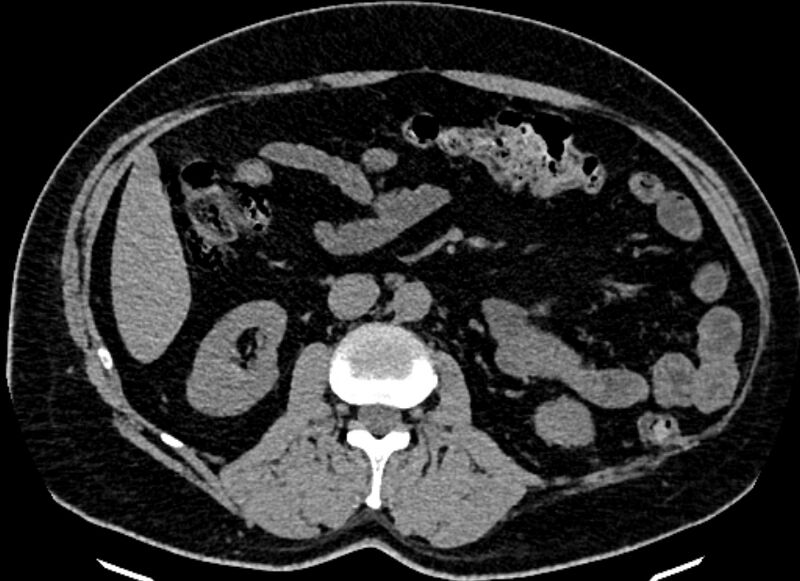 File:Adrenal metastases (Radiopaedia 73082-83791 Axial non-contrast 89).jpg