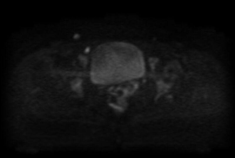 File:Adult granulosa cell tumor of the ovary (Radiopaedia 71581-81950 Axial DWI 19).jpg