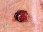 Amelanotic melanoma arising wihtin pigmented melanoma (DermNet NZ amelanotic-melanoma-018).jpg