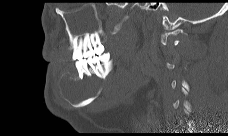 File:Ameloblastoma (Radiopaedia 33677-34806 Sagittal bone window 24).png