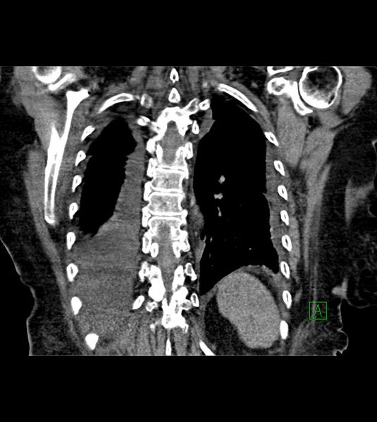 File:Amiodarone deposition in the liver (Radiopaedia 77587-89780 Coronal non-contrast 59).jpg