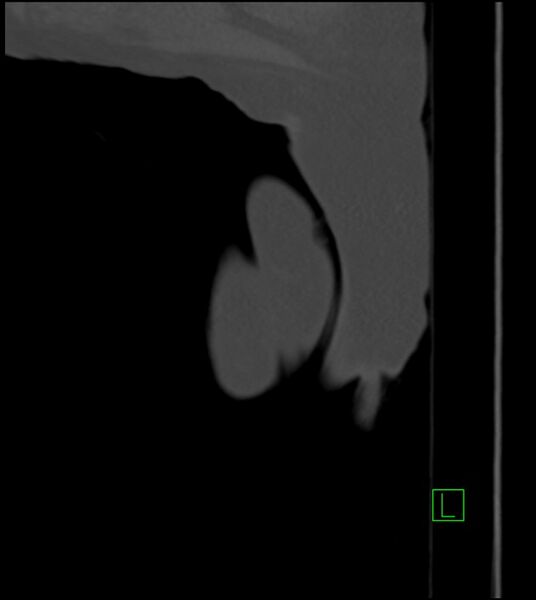 File:Amiodarone deposition in the liver (Radiopaedia 77587-89780 Sagittal bone window 105).jpg