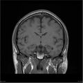 Amnestic syndrome secondary to hypoxic brain injury (Radiopaedia 24743-25004 B 14).jpg
