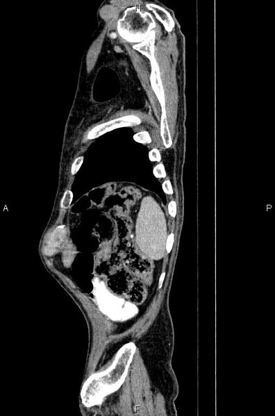 File:Ampullary adenocarcinoma (Radiopaedia 86093-102033 E 85).jpg