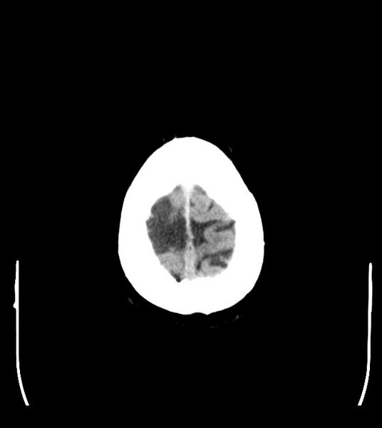 File:Anaplastic oligodendroglioma (Radiopaedia 79571-92753 Axial non-contrast 49).jpg