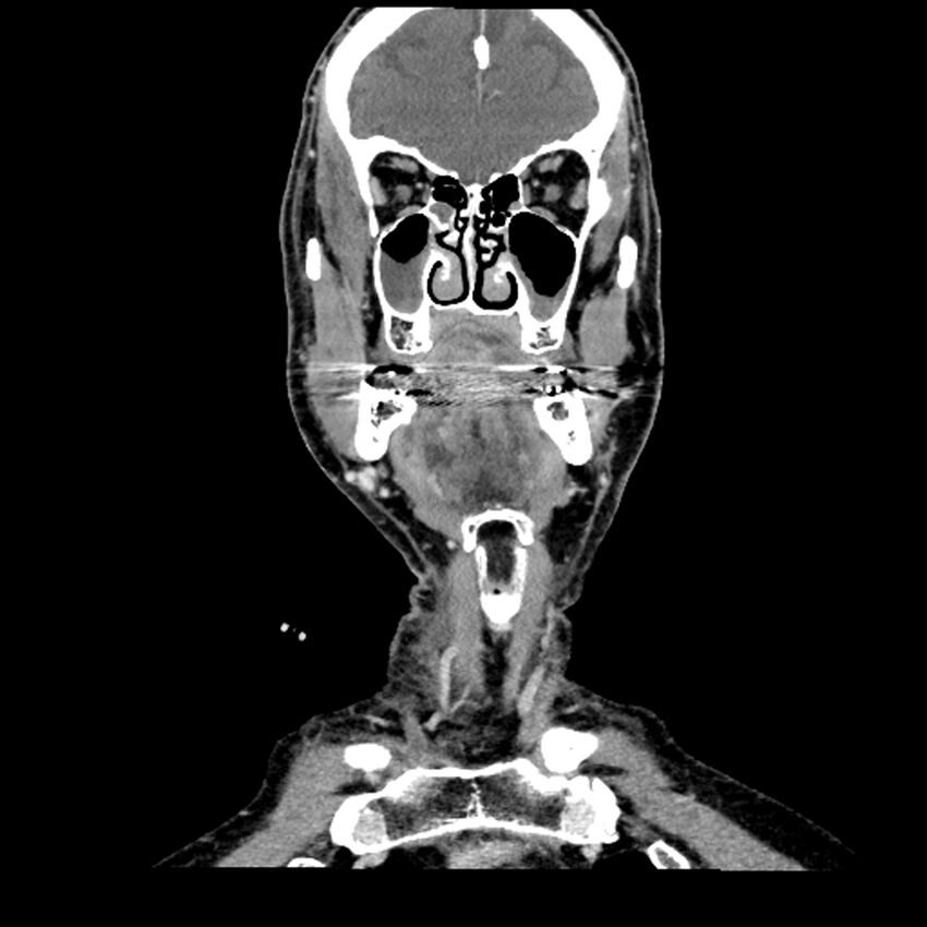 Anaplastic thyroid carcinoma (Radiopaedia 79087-92034 A 43).jpg