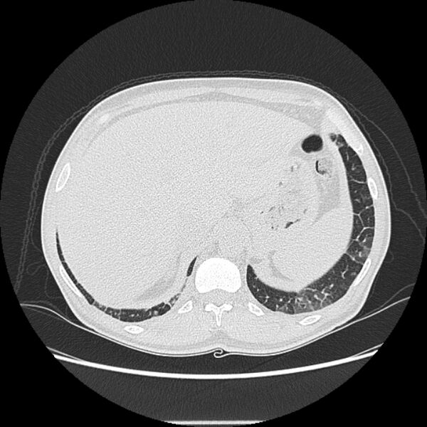 File:Angioinvasive aspergellosis (Radiopaedia 66995-76315 Axial lung window 48).jpg