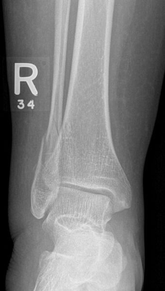 File:Ankle fracture - Weber C (Radiopaedia 10965-11383 Frontal 1).jpg