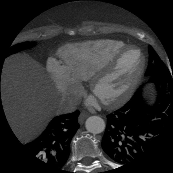 File:Anomalous origin of left circumflex artery from right coronary sinus (Radiopaedia 72563-83117 A 14).jpg