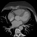 Anomalous origin of left circumflex artery from right coronary sinus (Radiopaedia 72563-83117 A 34).jpg