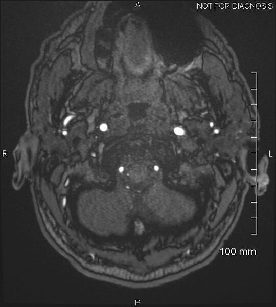 File:Anterior cerebral artery aneurysm (Radiopaedia 80683-94127 Axial MRA 7).jpg