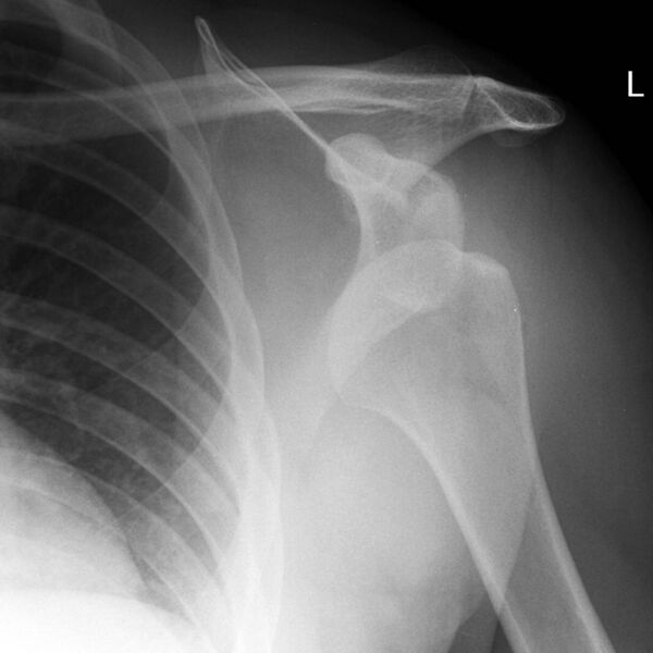 File:Anterior shoulder dislocation (Radiopaedia 9158-9858 Frontal 1).jpg