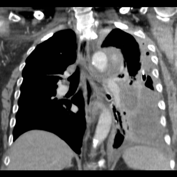 File:Aortic arch false aneurysm (Radiopaedia 14667-14588 B 12).jpg