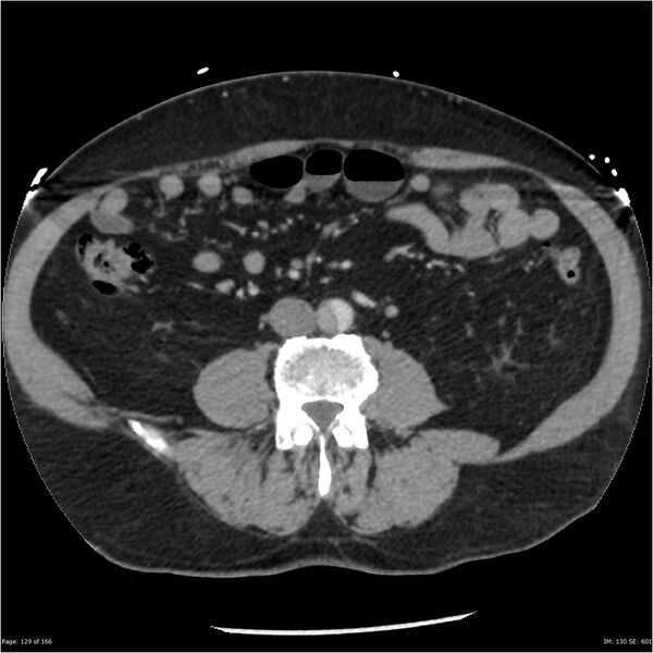 File:Aortic dissection- Stanford A (Radiopaedia 37759-39664 A 120).jpg